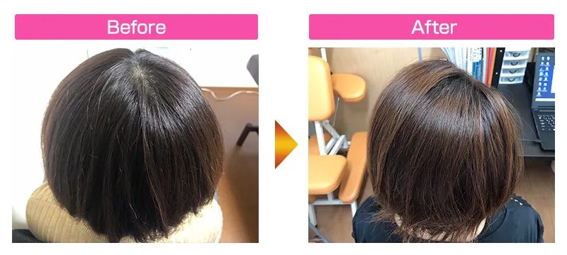 【発毛】40代女性 施術3ヶ月のビフォーアフター